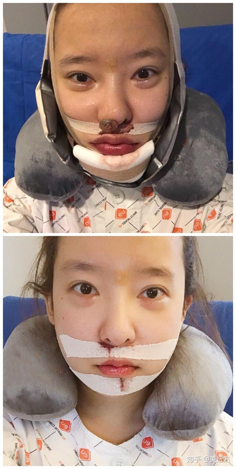 做正颌手术是怎样的体验