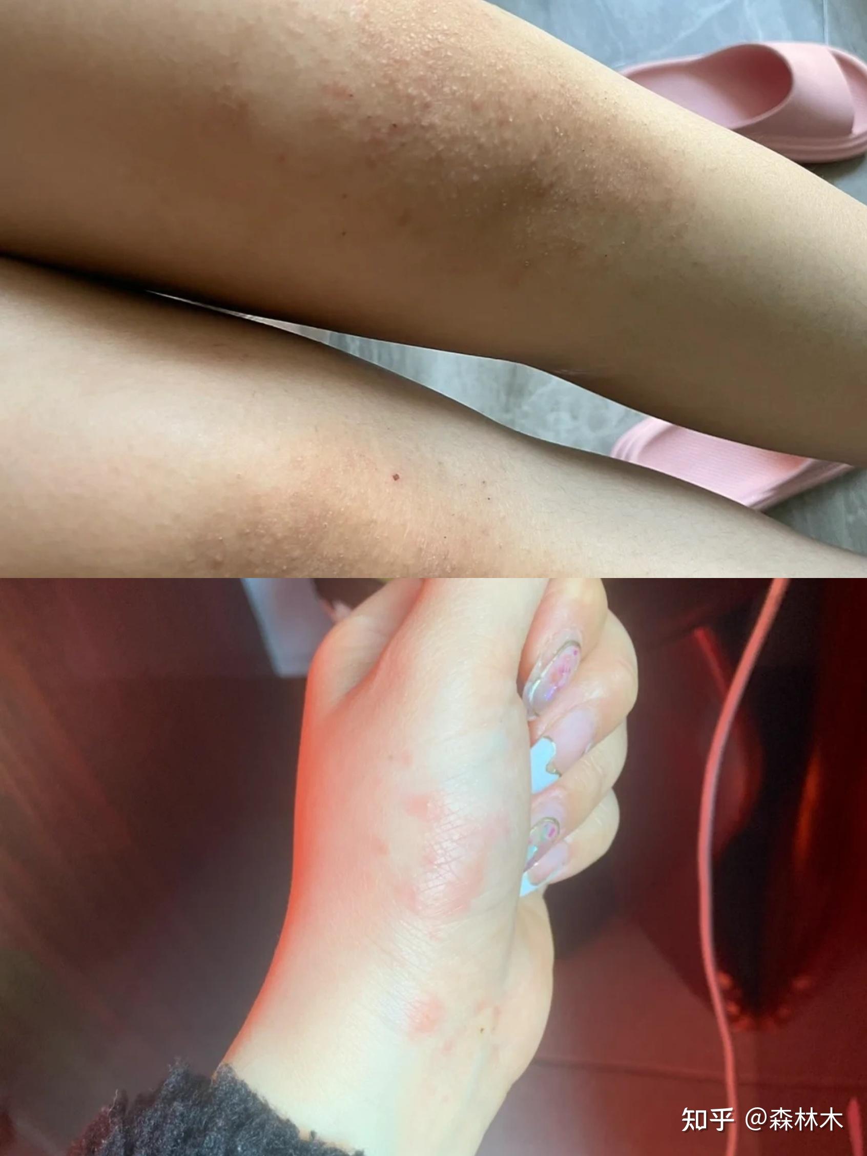 (保姆级个人湿疹痊愈经验贴)如果你的湿疹反反复复,经常瘙痒难耐,忍不