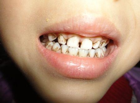 宝宝牙齿发黄怎么办,如何预防孩子牙齿变黄