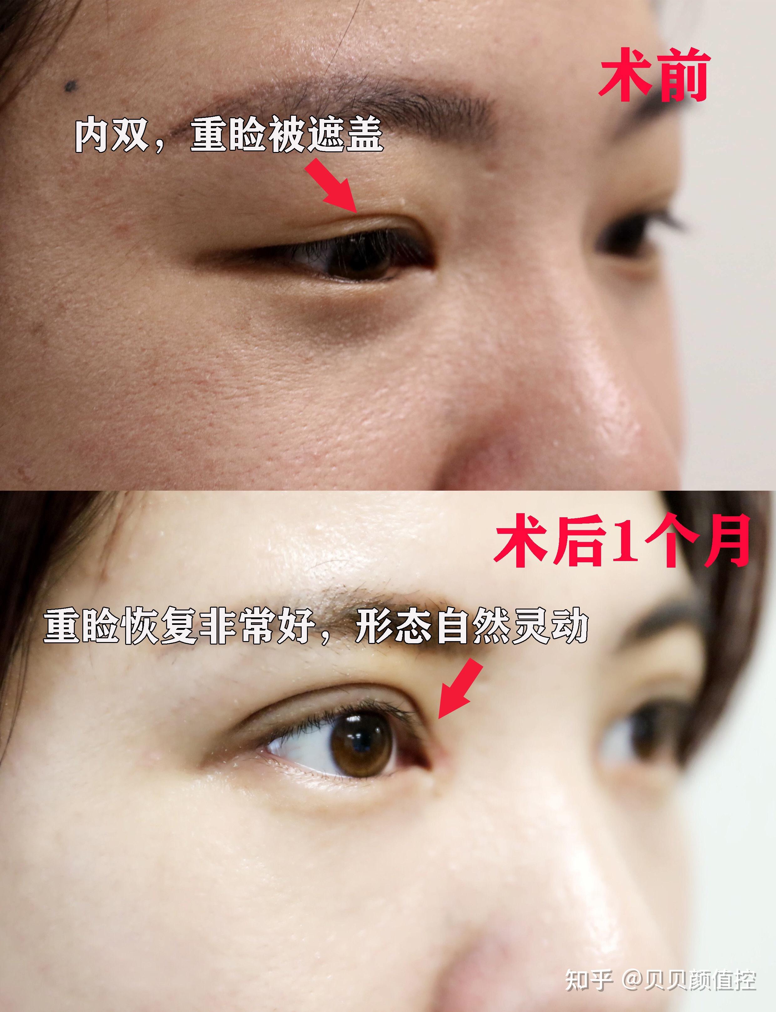 为什么眼综合被称为医美入圈项目