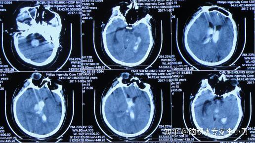 脑出血后脑室引流和腰大池术后并发症 脑积水并脑室旁水肿 颅内感染 李小勇脑脊液科治疗后恢复至基本正常 脑出血引流术后并发症