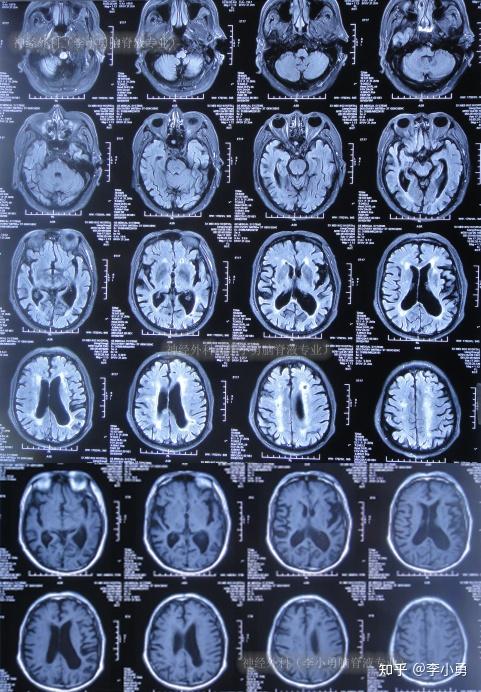 81岁老年脑积水腰大池分流术反致颅内感染颅内出血及走路不能2年余