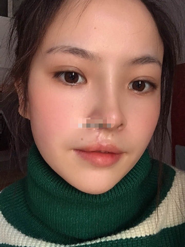 修复完全,因为小时候家里没钱,就没继续做了,长大后才来继续做的修复