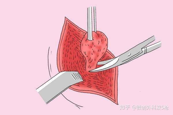 女孩患乳腺纖維腺瘤借到錢後主動退回網絡籌款這個病嚴重嗎