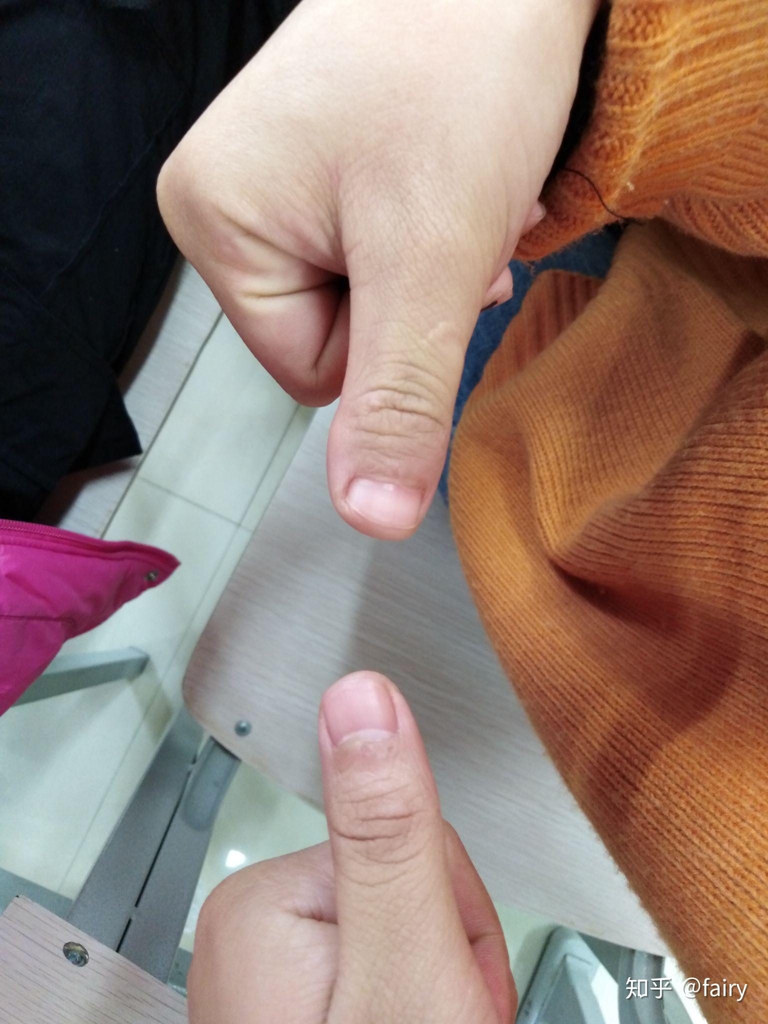 为什么我的大拇指又宽又短