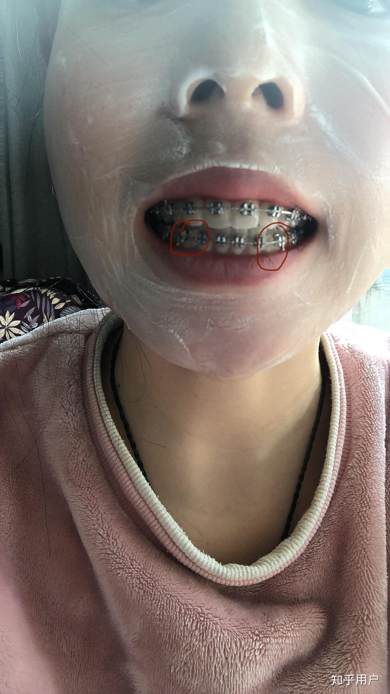 二十七岁带牙套有必要吗? - 知乎