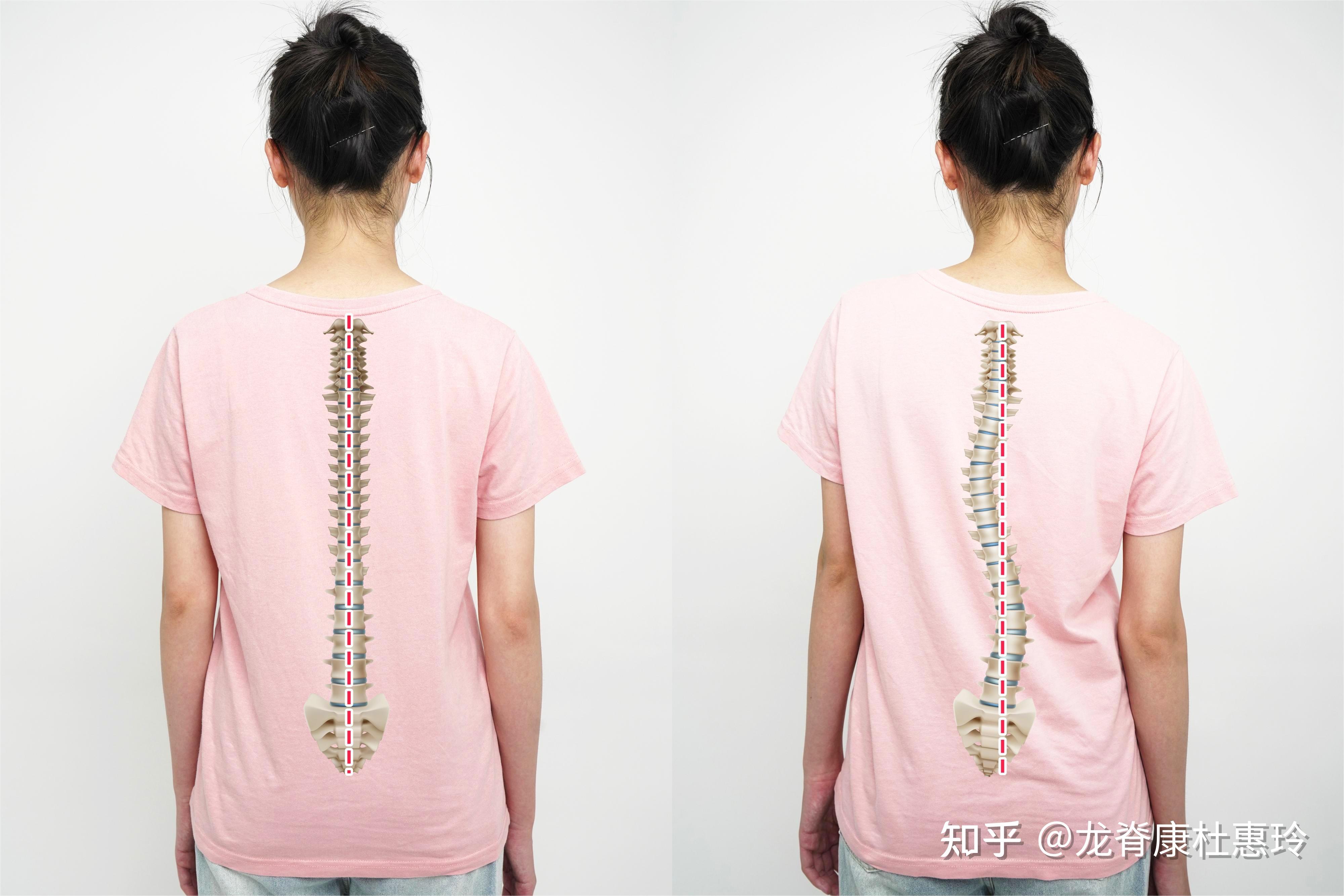 70°大角度侧弯患者,经过三年治疗变化如何?