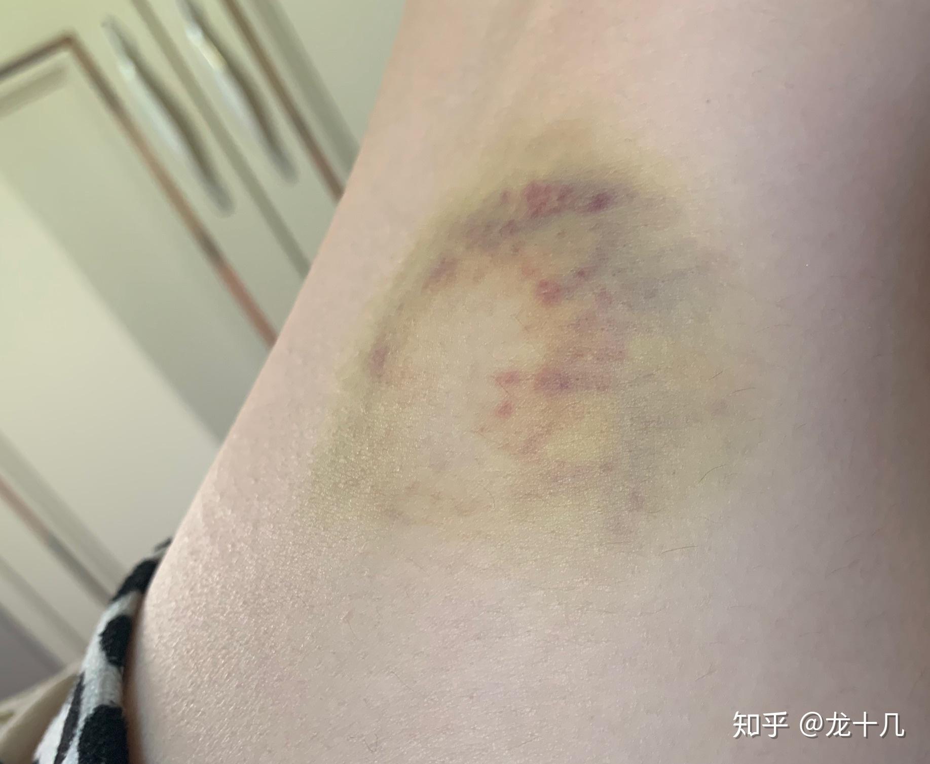 为什么身上莫名其妙有淤青