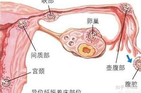 怀孕反应着床会出血吗_怀孕刚着床的6个反应_怀孕的着床反应