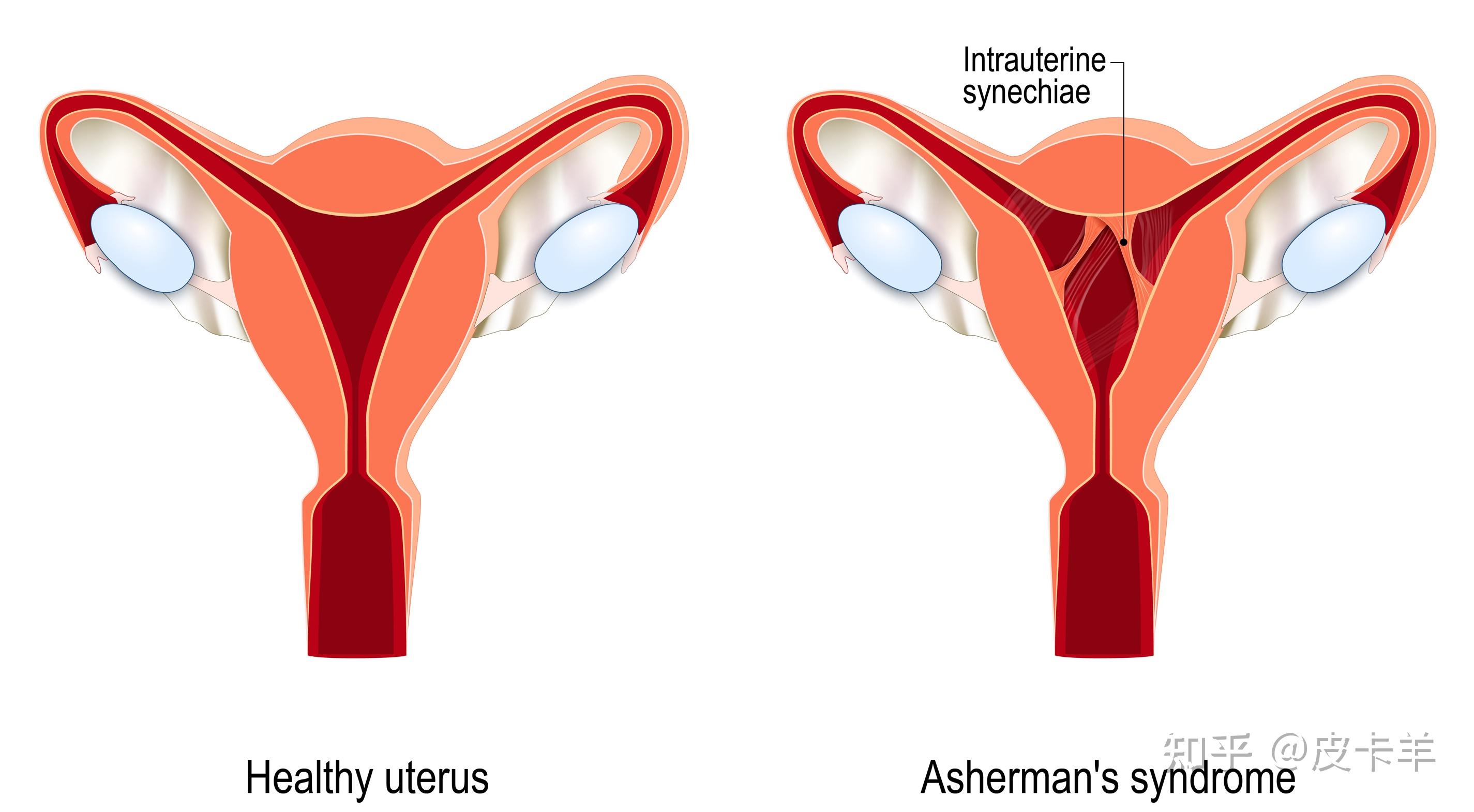 子宫粘连有什么症状? - 知乎