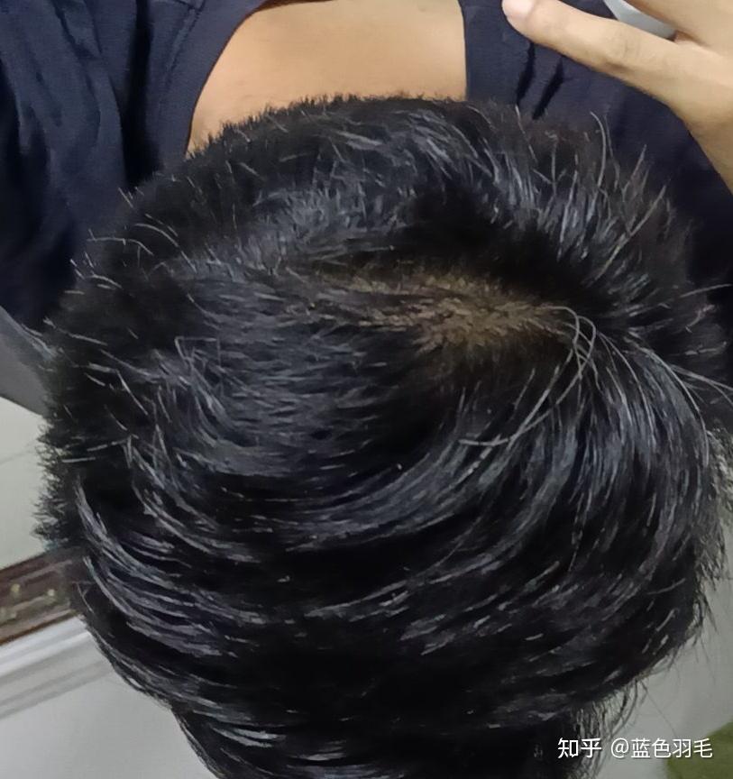 滚轮微针治疗脱发全程记录更新至202273