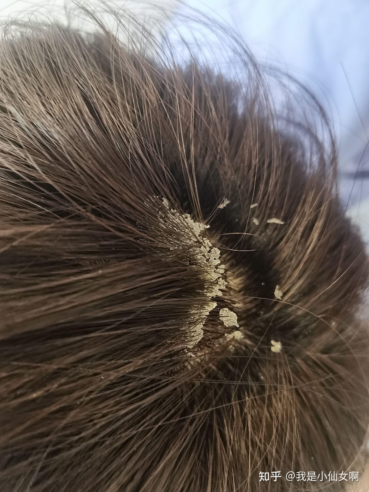 见过的最大头皮屑多大?