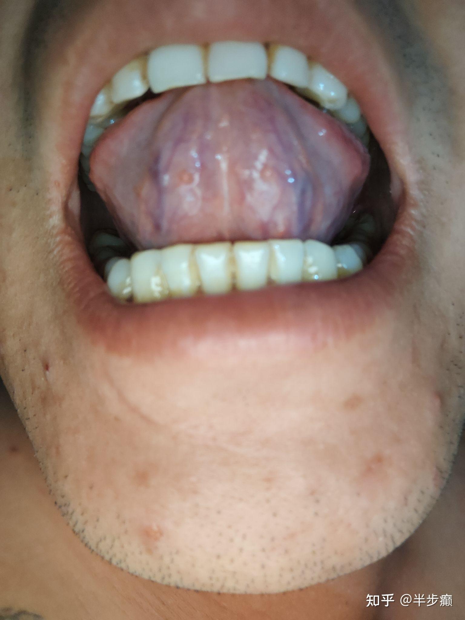舌头尖锐湿症状图舌下图片