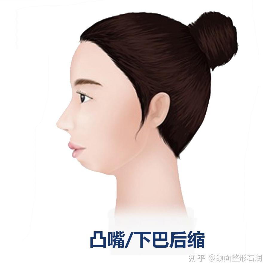 怎么确定是下巴后缩还是下颌后缩? - 知乎