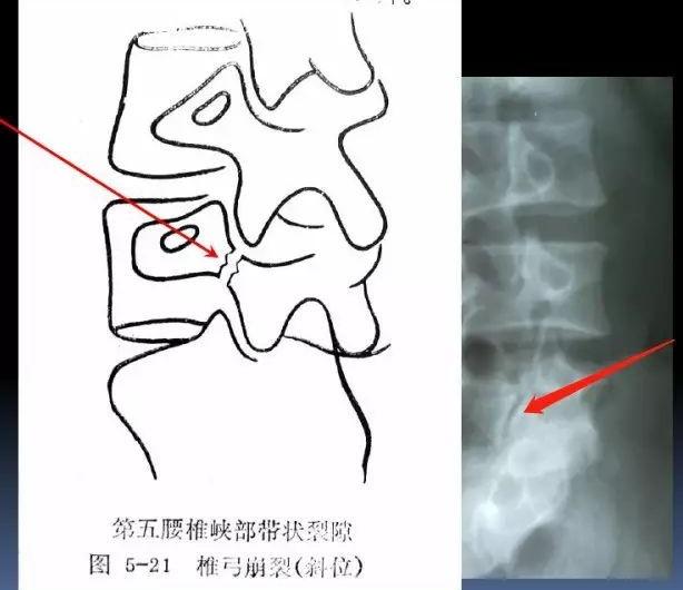 腰椎滑脱片子图片