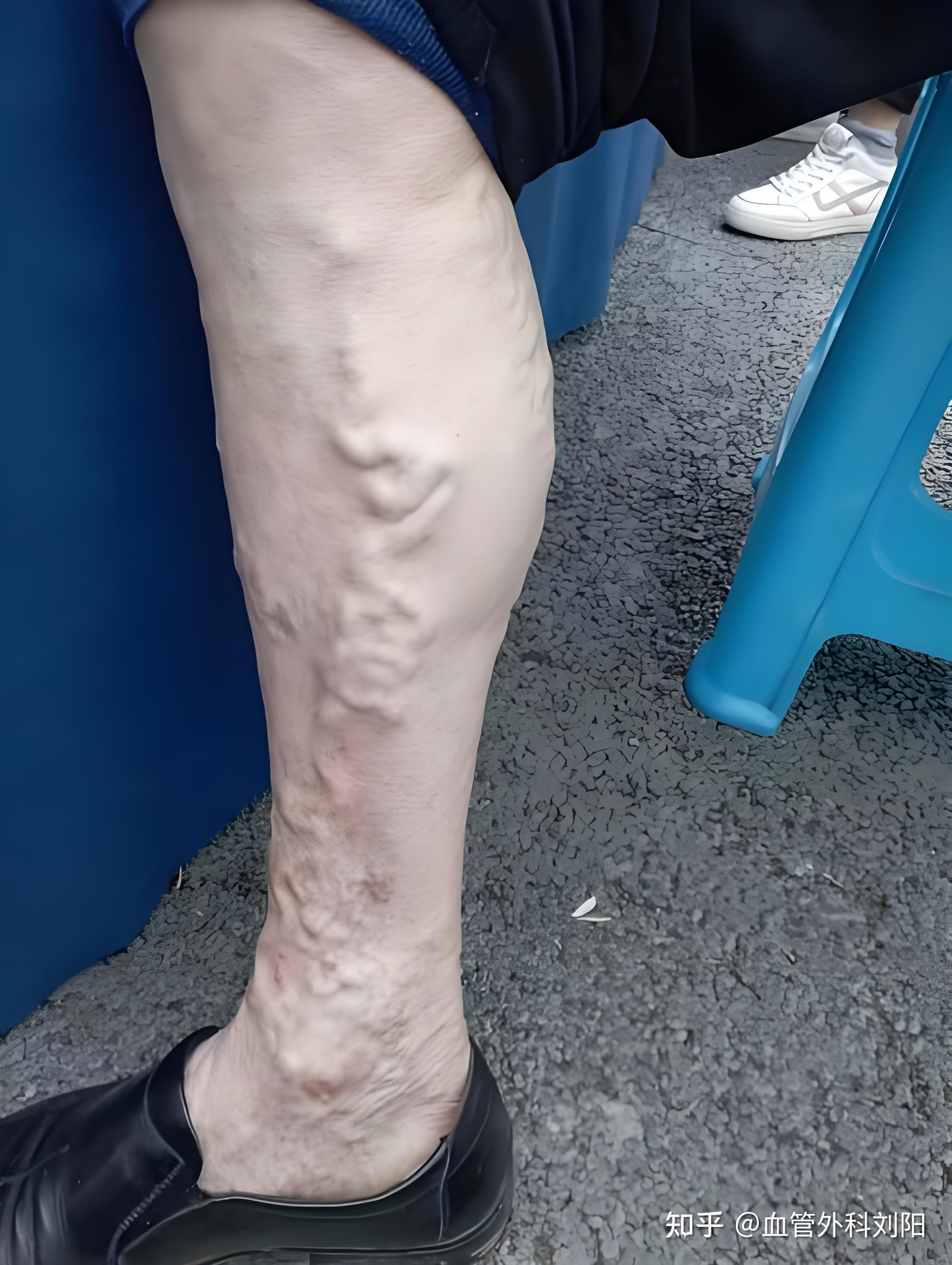 静脉曲张能不能治愈