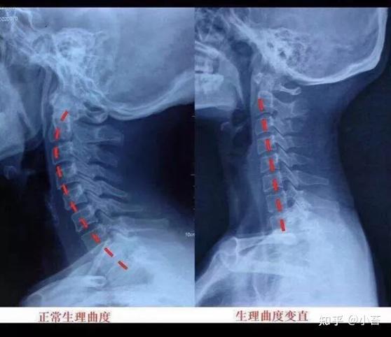 你以为是天鹅颈？其实是颈椎病！ - 知乎