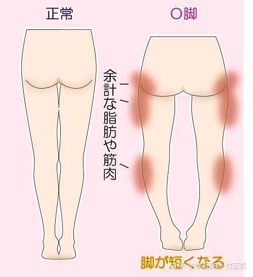 解构o型腿 知乎