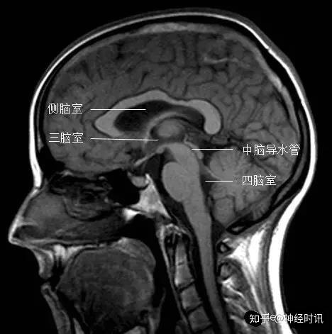 史上最全脑室解剖图谱快收藏了吧 - 知乎