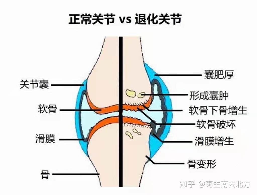膝盖是由软骨和硬骨组成的,关节软骨出了问题,膝盖不仅会疼痛僵硬