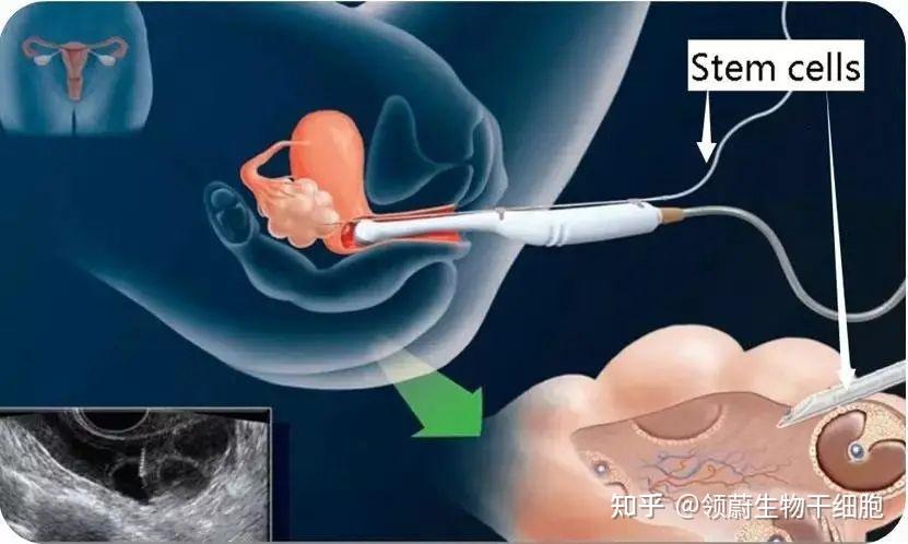 间充质干细胞助你逆转更年期，解决卵巢早衰和提前闭经问题 知乎 2880