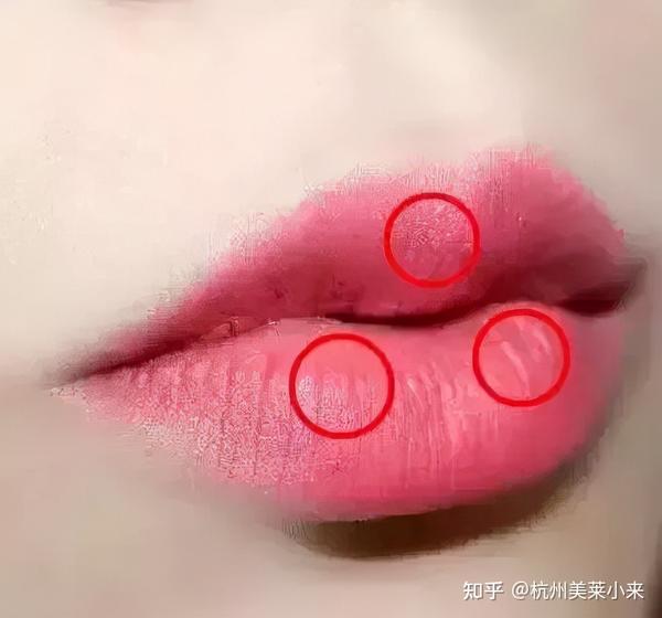 杭州玻尿酸丰唇后,kiss 会被发现吗? - 知乎