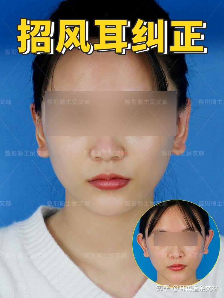 深受日本人喜爱的招风耳为何有些人要矫正