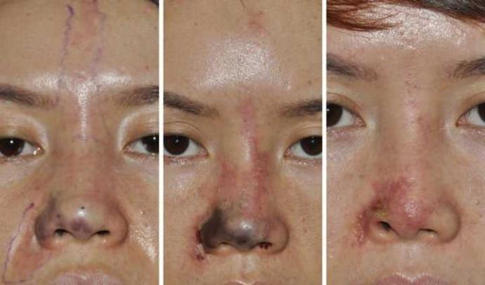 用玻尿酸隆鼻头也是有风险的