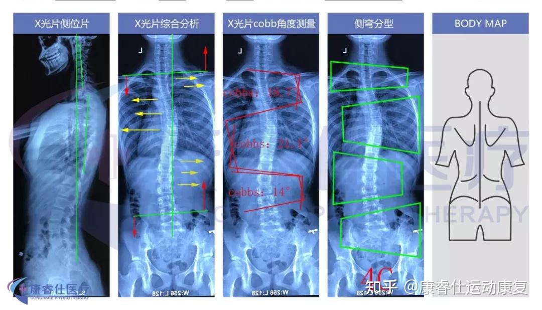 案例分享|脊柱侧弯虽比你想象的可怕,可治! - 知乎