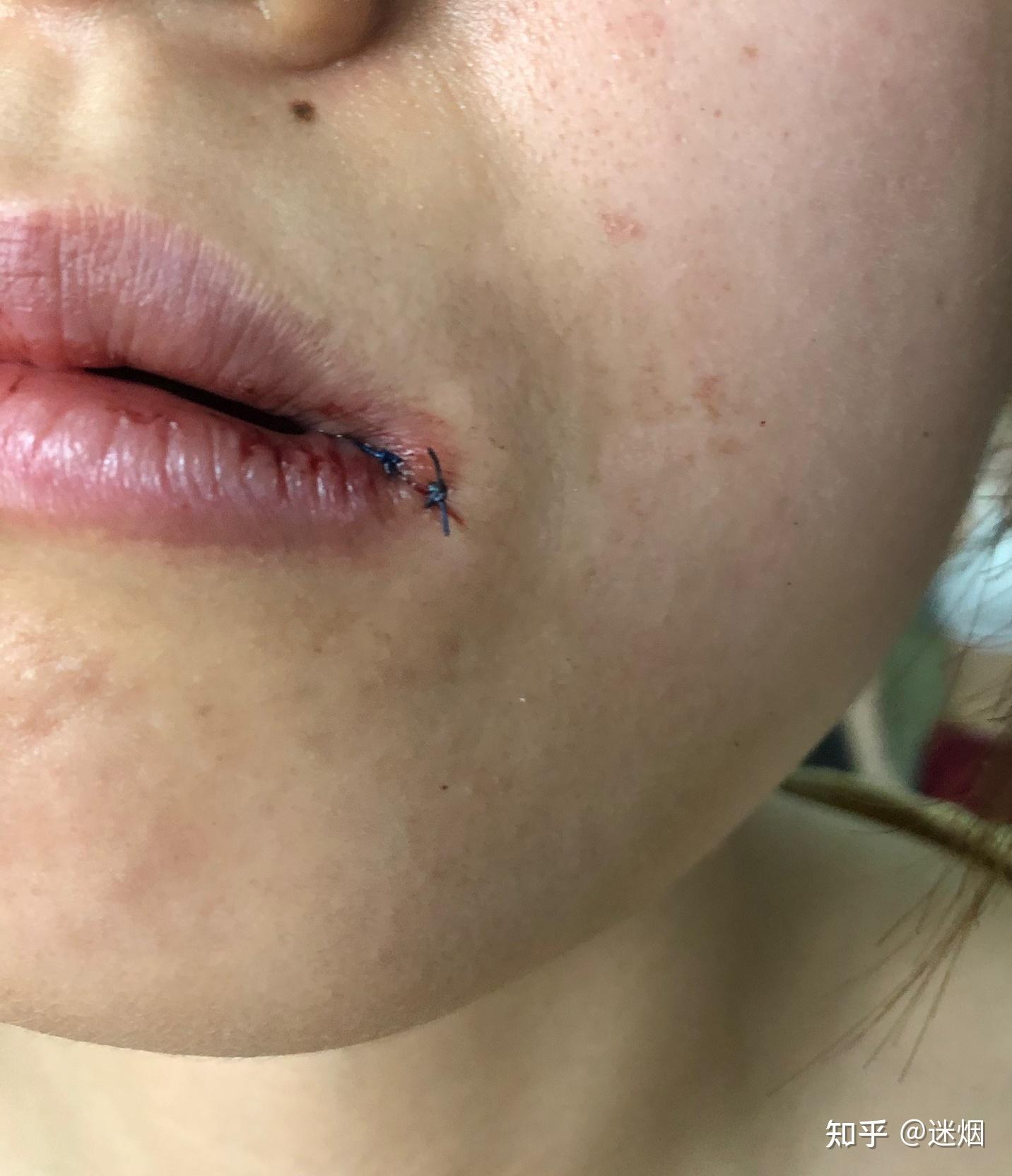 有没有人因为拔牙而造成嘴角撒裂的