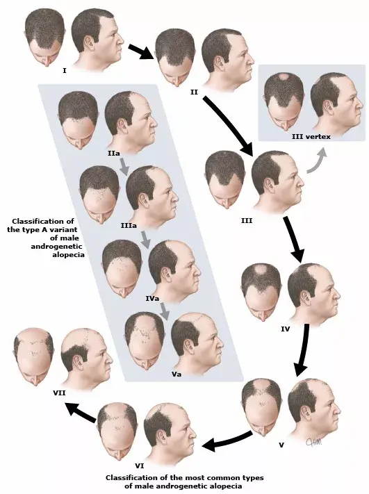 遗传之外这是风险第二高的脱发原因