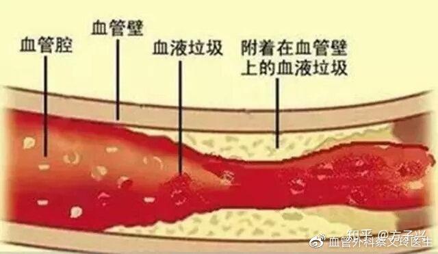 血管堵了吗？不怕，一个小动作冲走夺命血栓 - 知乎