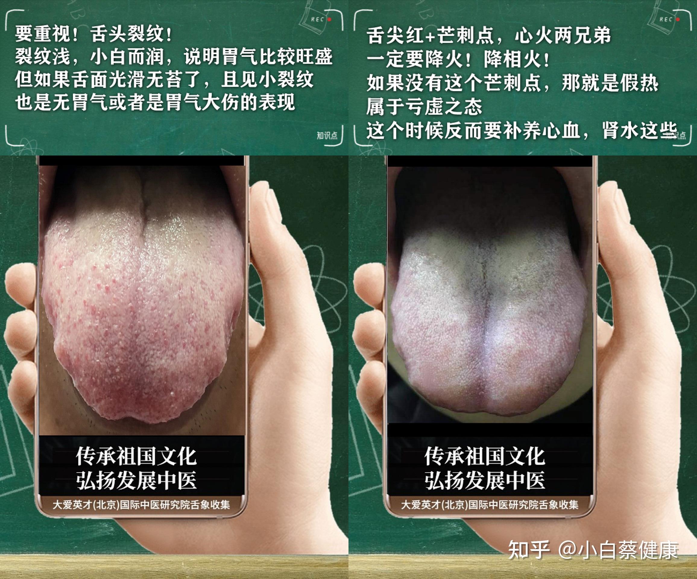 解答:結腸炎,脾虛氣滯,膽木克胃土.主要症狀:患上了結腸炎已久,反反覆