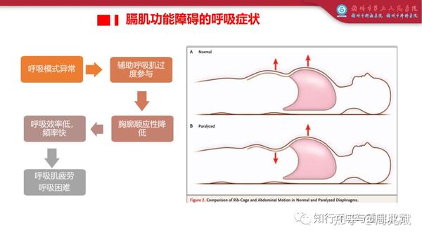 第129期 膈肌功能的精准化评估 - 知乎