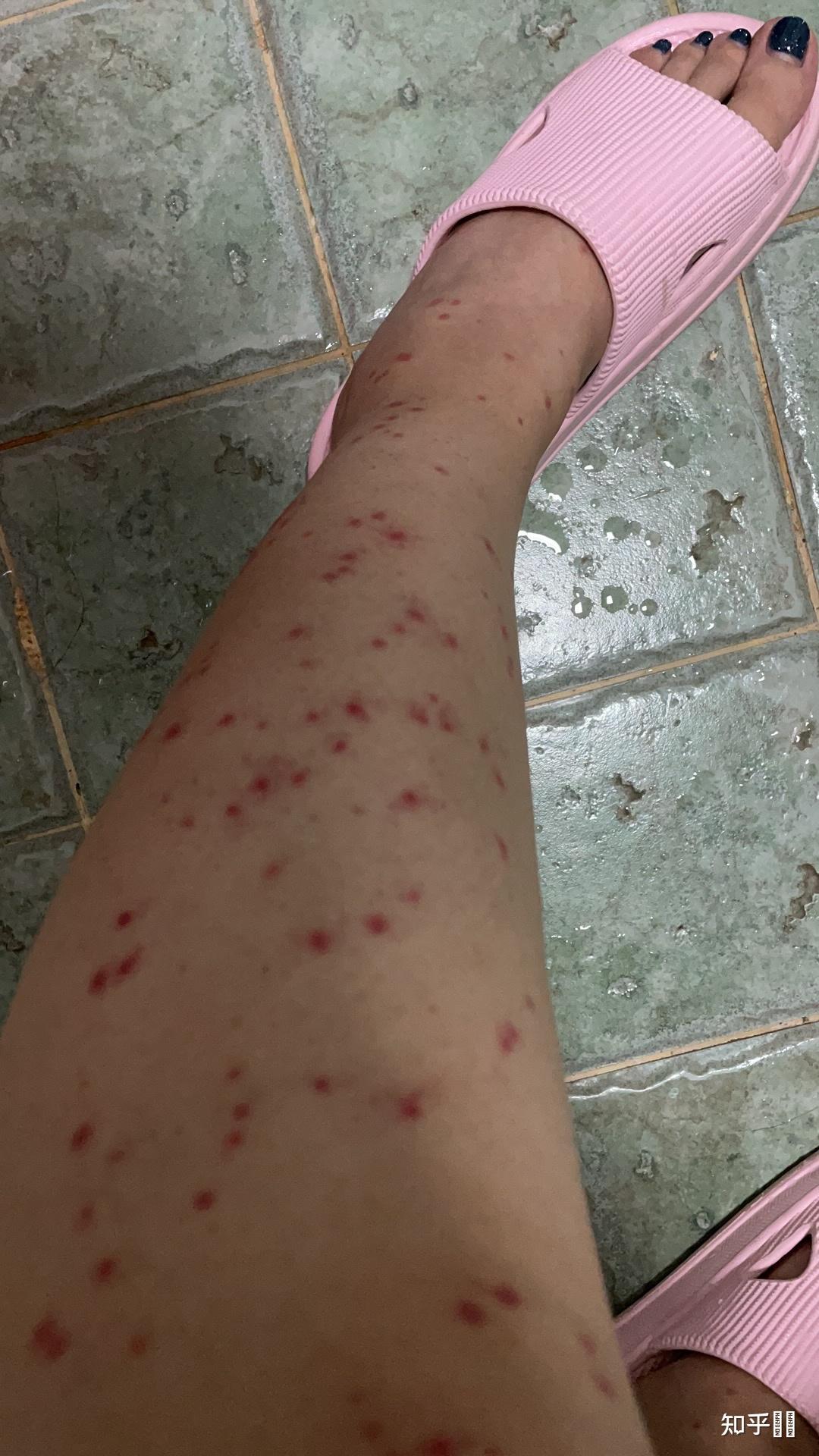 你被蚊子咬到最惨痛的一次经历是什么? - 知乎