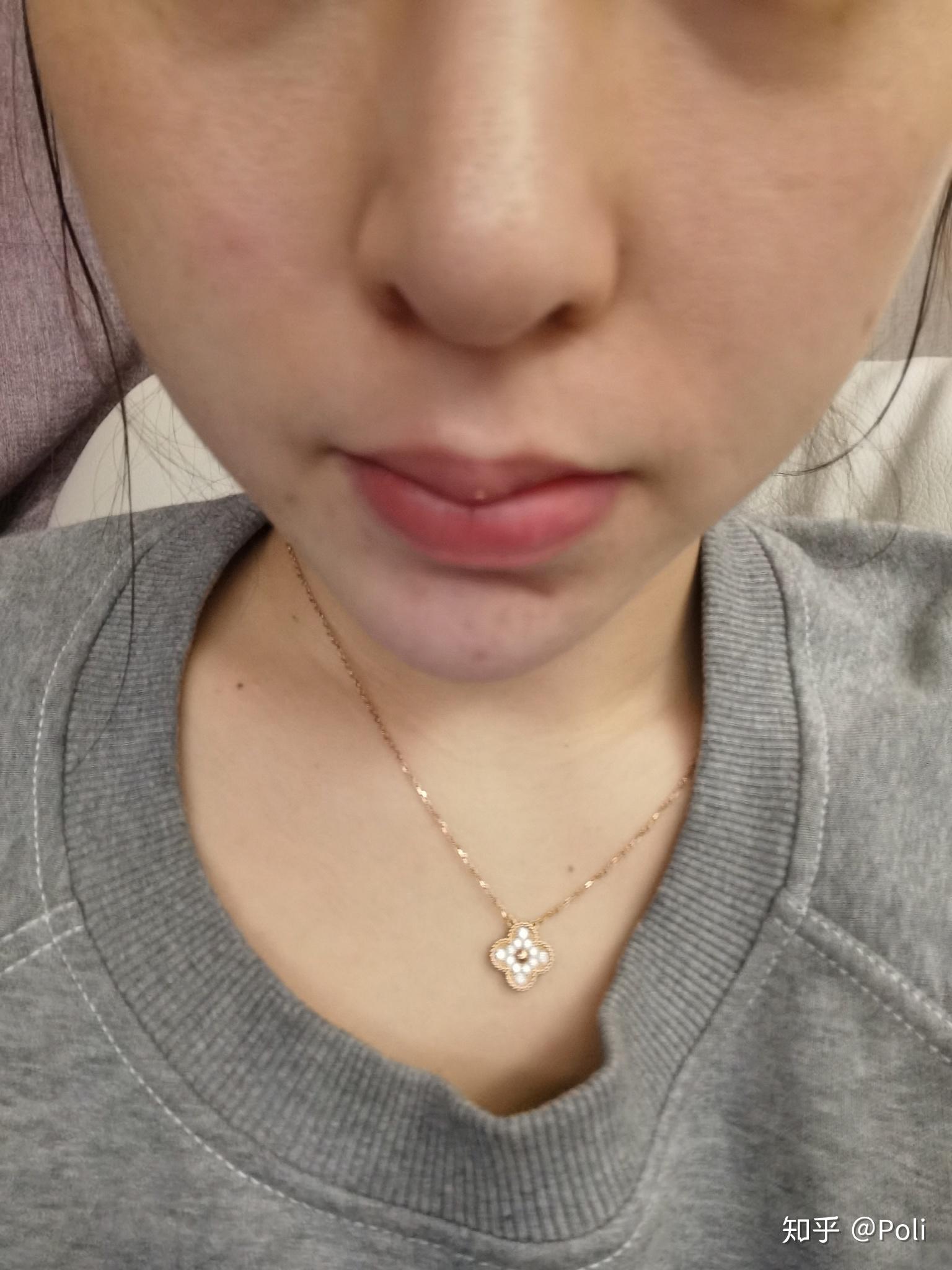 第二次鼻修复第三个月鼻头还是往下掉