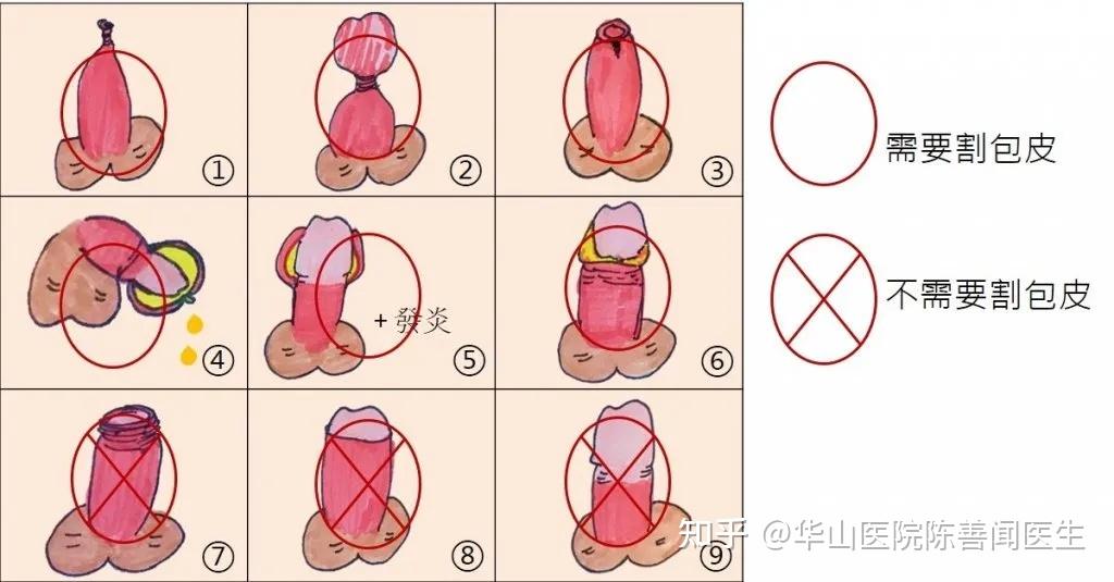 包皮过长一定要割包皮吗?除了手术之外,原来还可以这样做