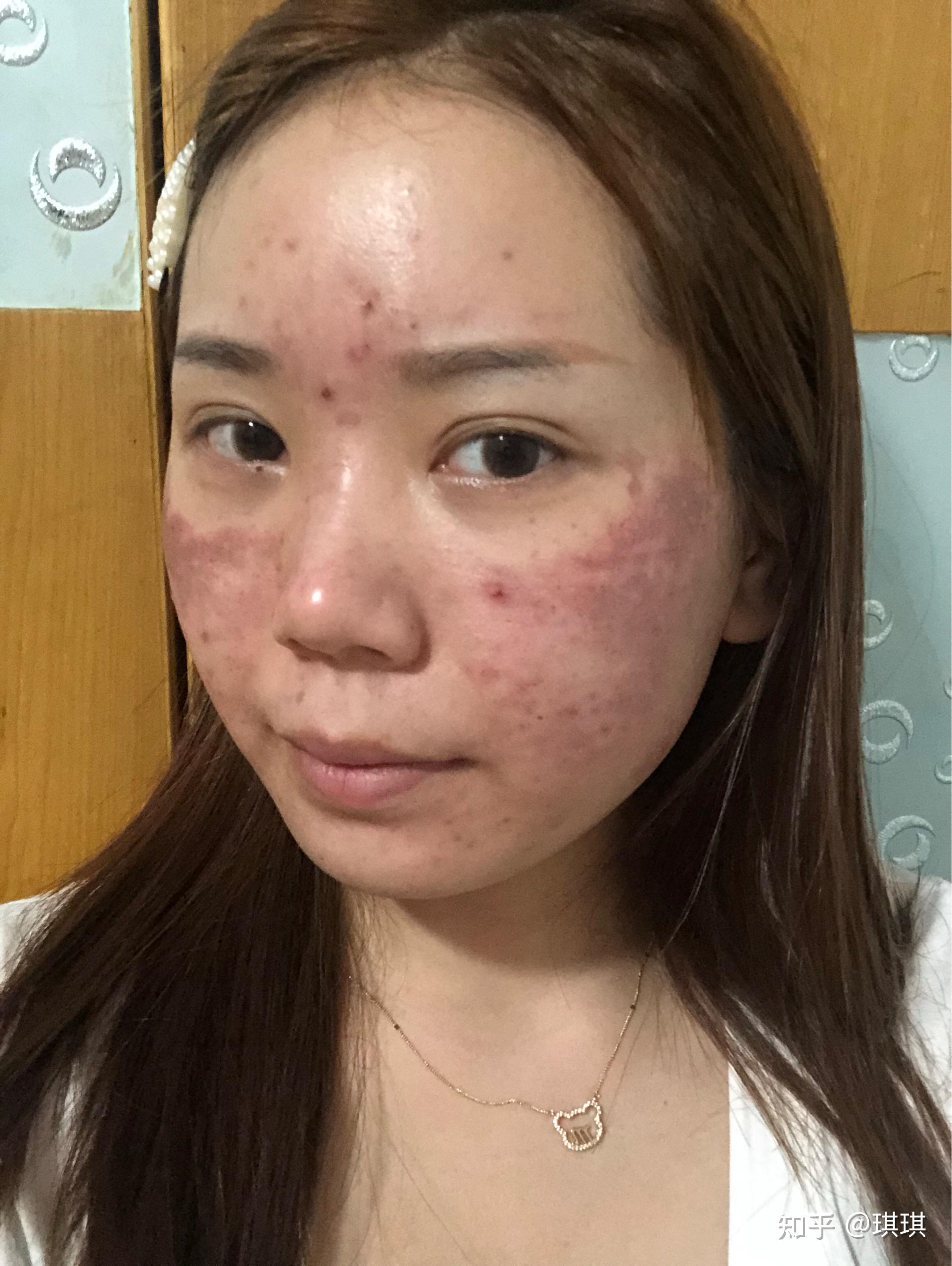 去医院做完水杨酸焕肤脸上烧伤第二天掉皮露出肉怎么办? - 知乎