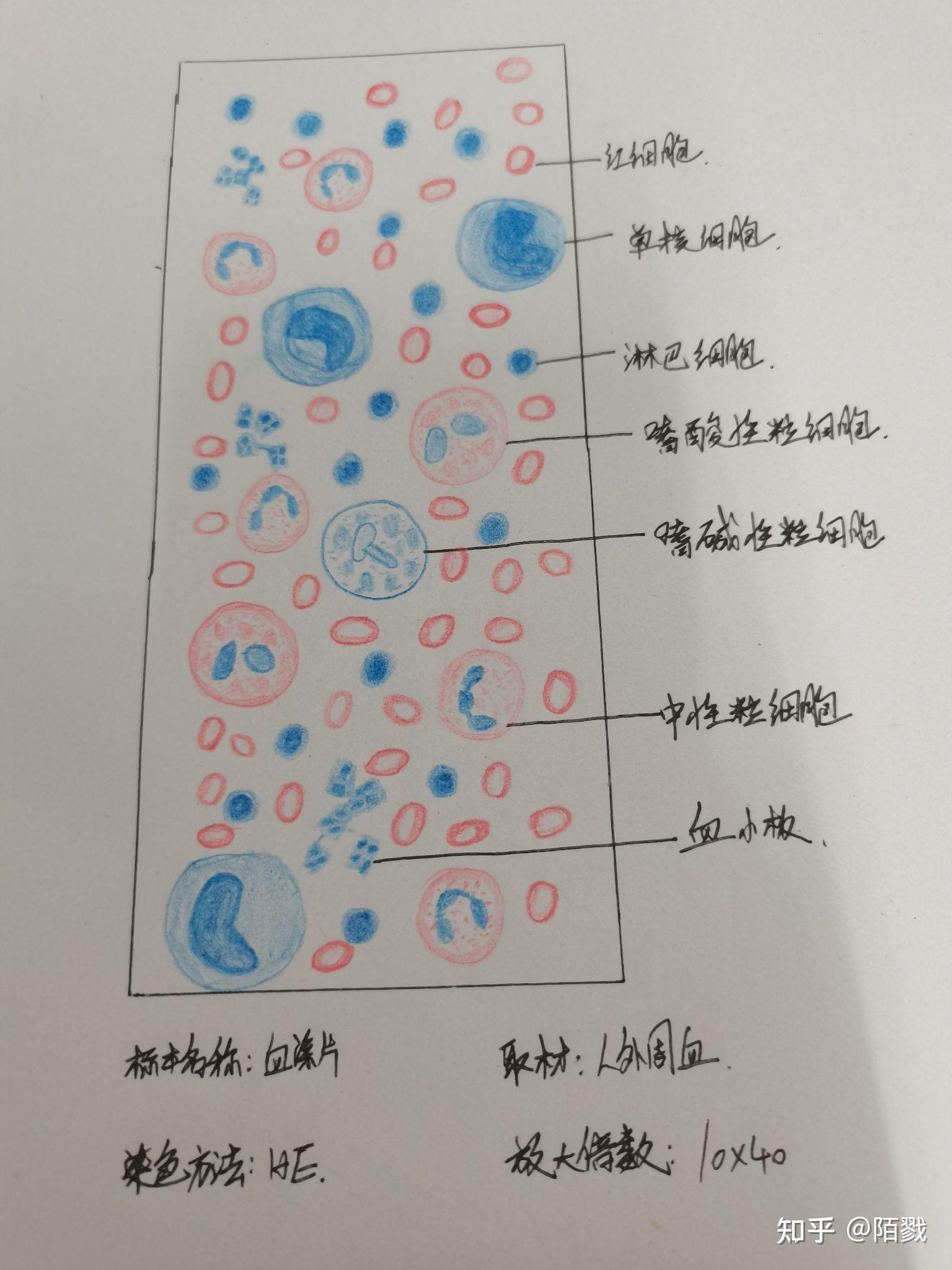 炎性细胞红蓝铅笔图图片