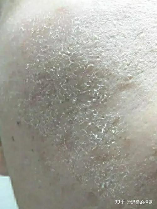 为什么洗完脸三分钟就起干皮? - 知乎
