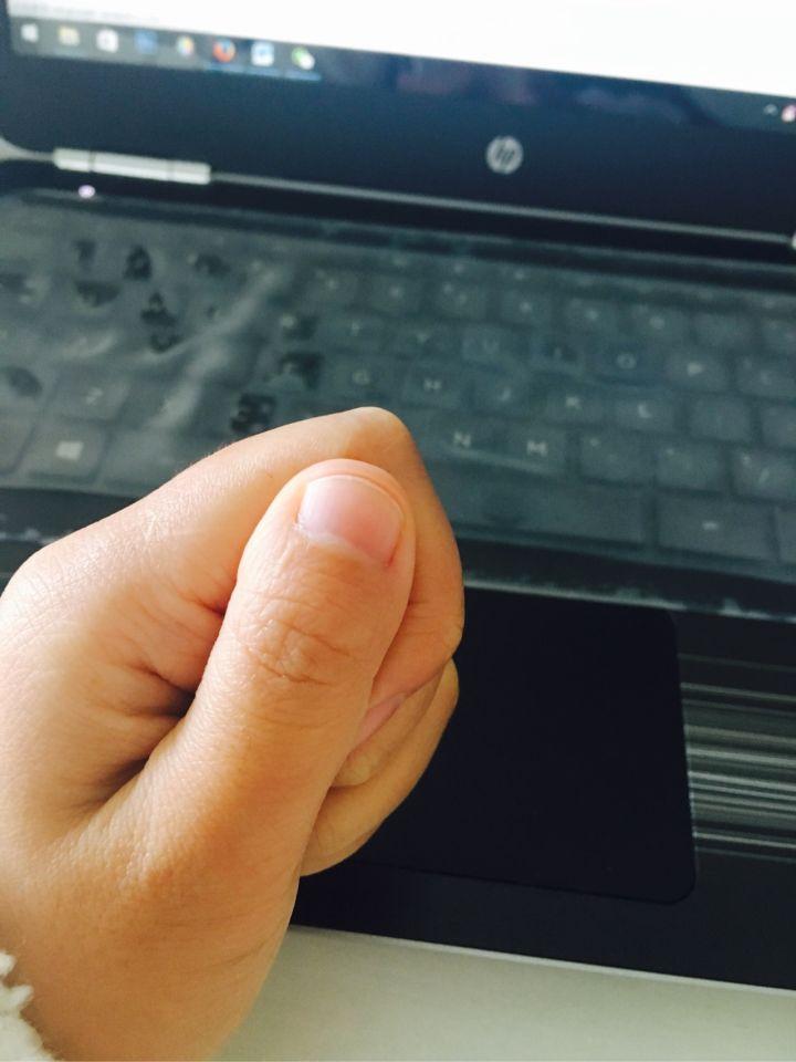 brachydactyly 短指症 - 知乎