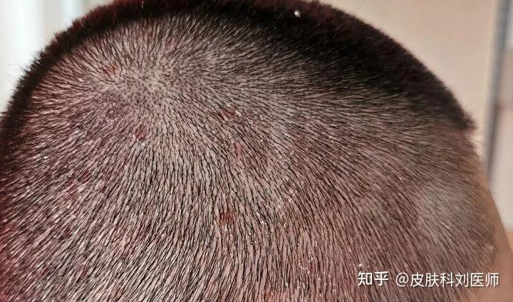 而造成「马拉色菌」过度繁殖的诱因一般属于局部皮肤免疫力失衡,造成