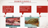 体检查出胆囊息肉怎么办防止癌变5类人的胆息肉建议切除