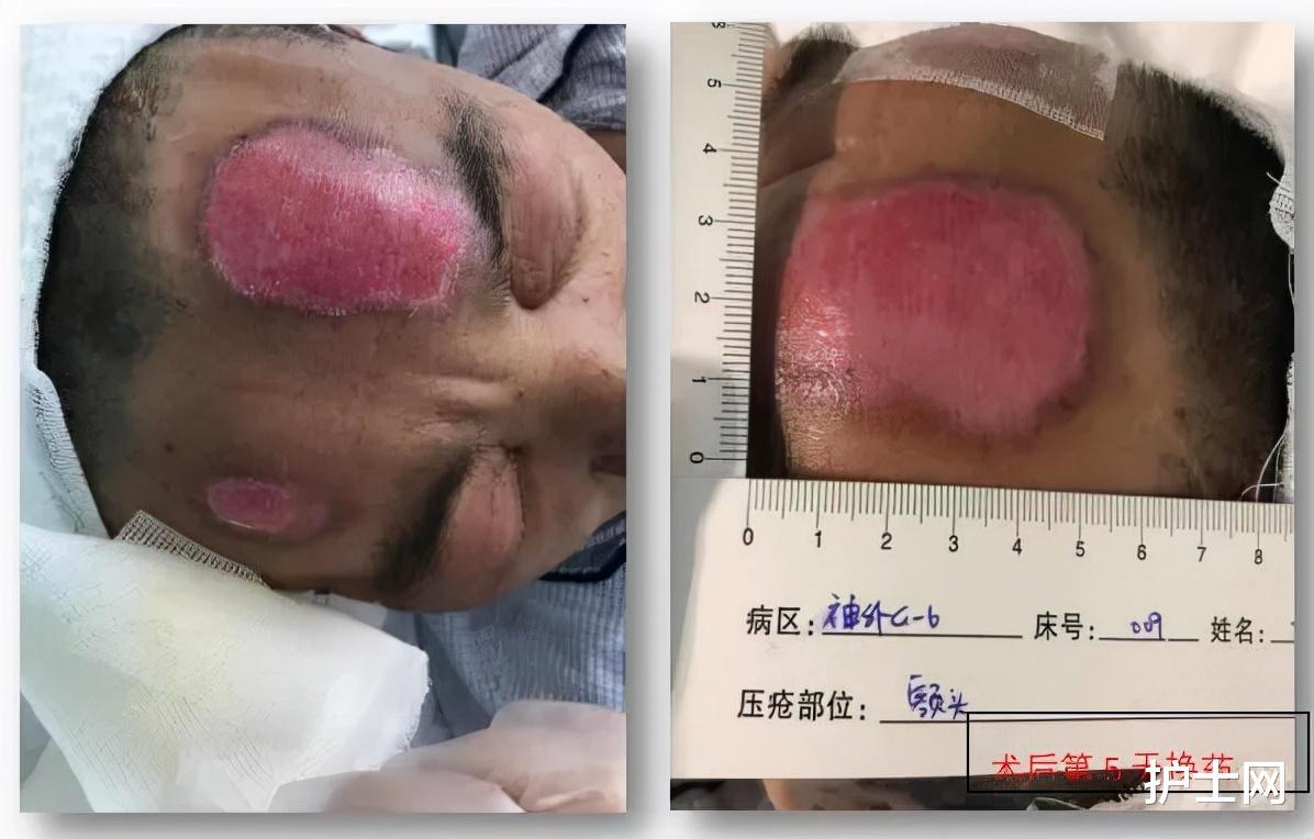 术中产生2期压力性损伤这事本可预防附护理方法