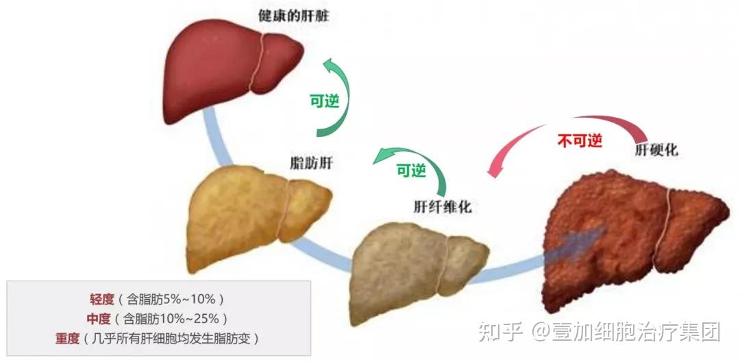 有權威專家指出,脂肪肝的發展大多遵循著