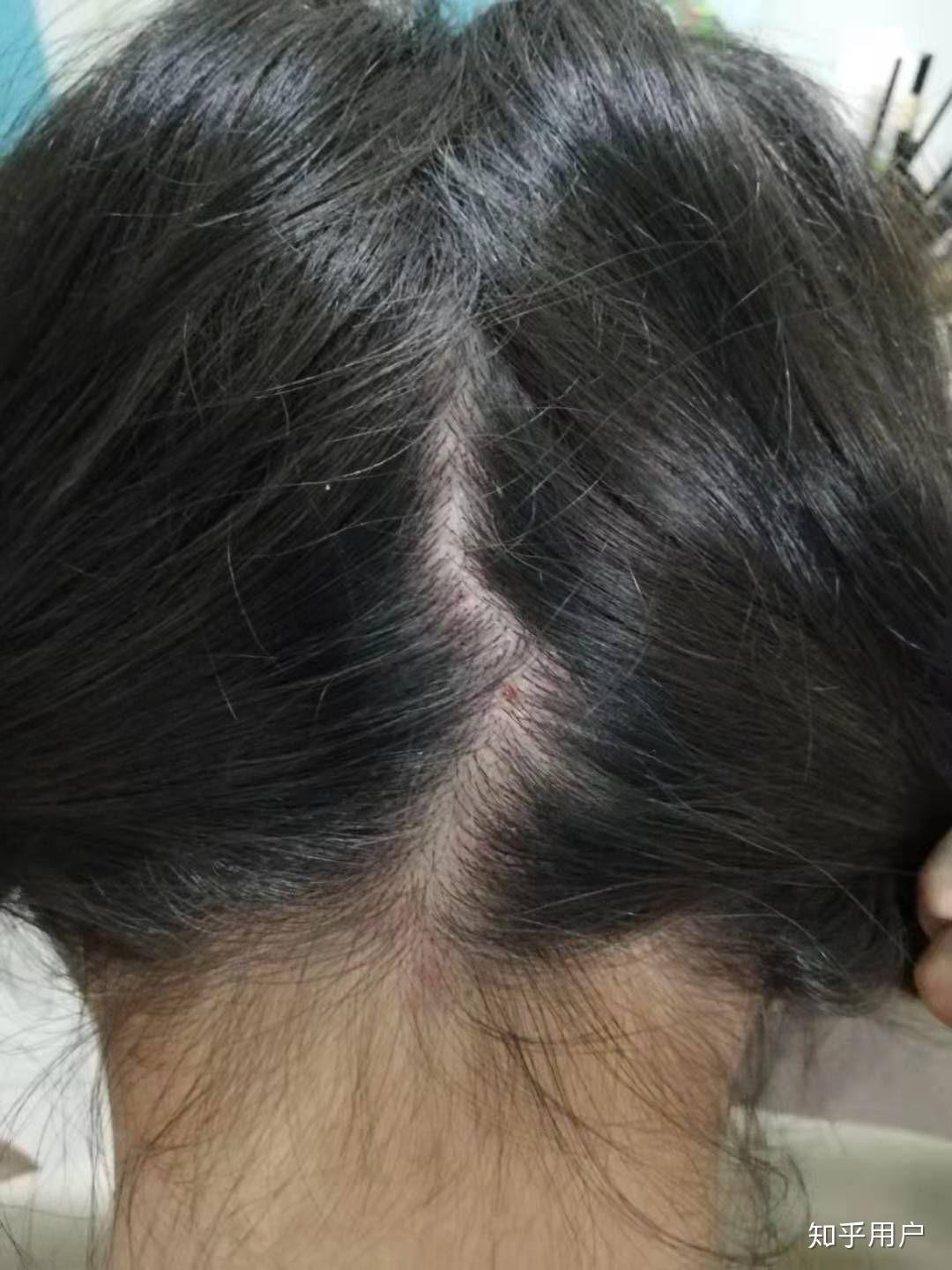 头皮上老是长痘痘,扣了是个血痂要不然就是按着疼的包,这是啥玩意啊?