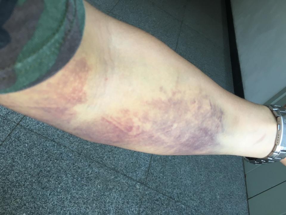 着急,请问抽血后整只胳膊都又紫又青的这是怎么回事?