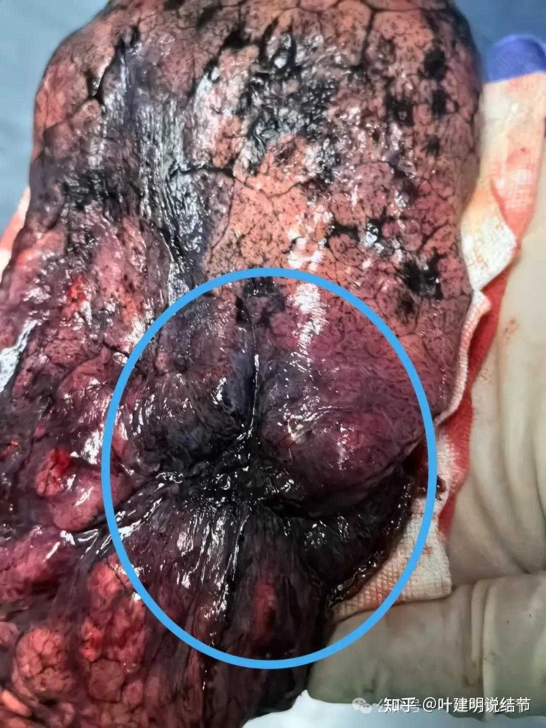 5.7):左肺典型的囊腔型肺癌,中药吃了半年会有效果吗?