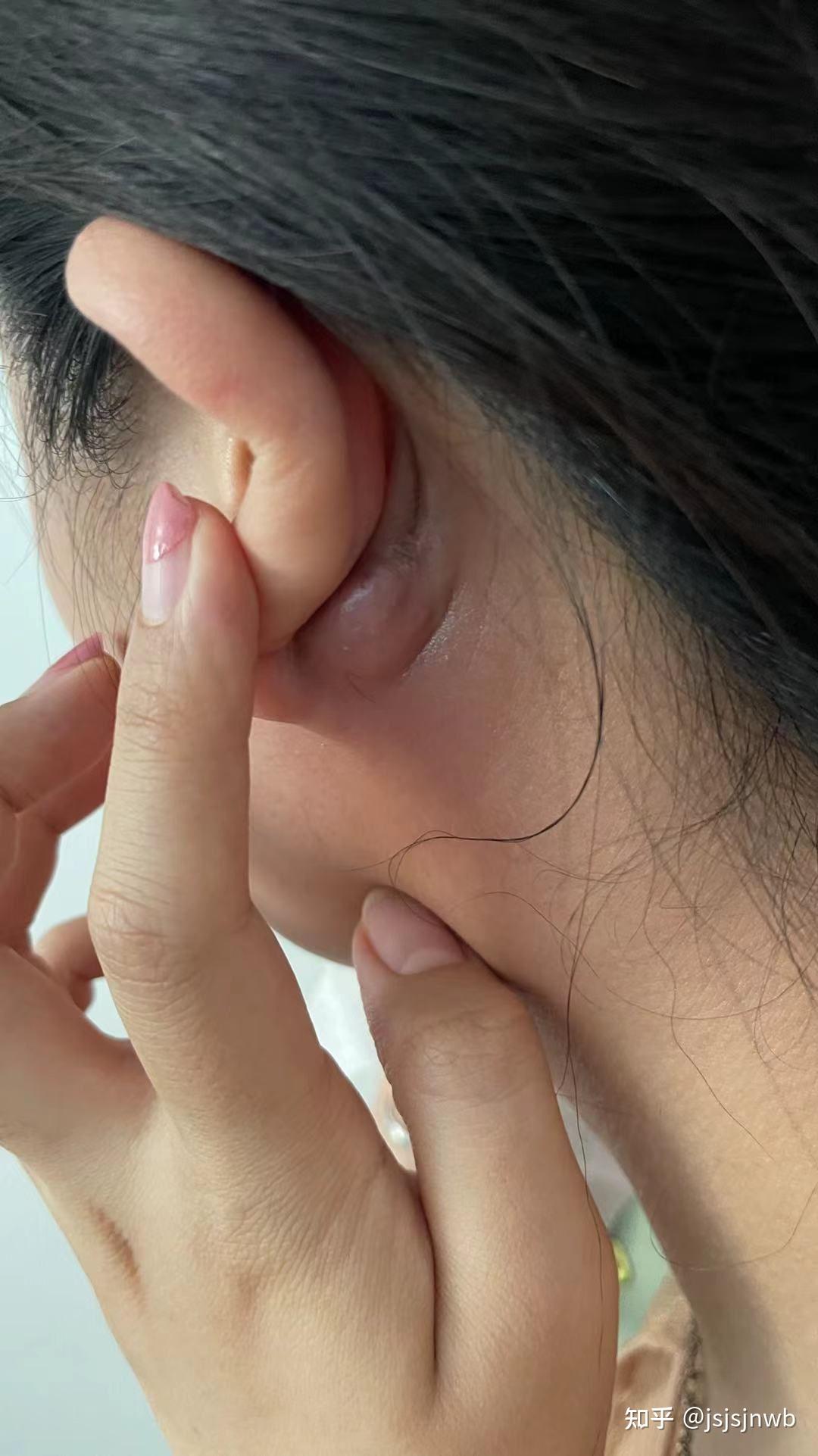 耳朵附近的淋巴位置图图片