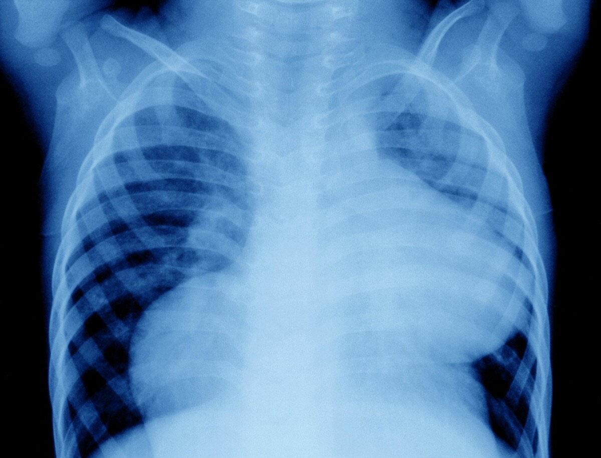 肺原位腺癌基因突变 肺原位癌能影有寿命吗